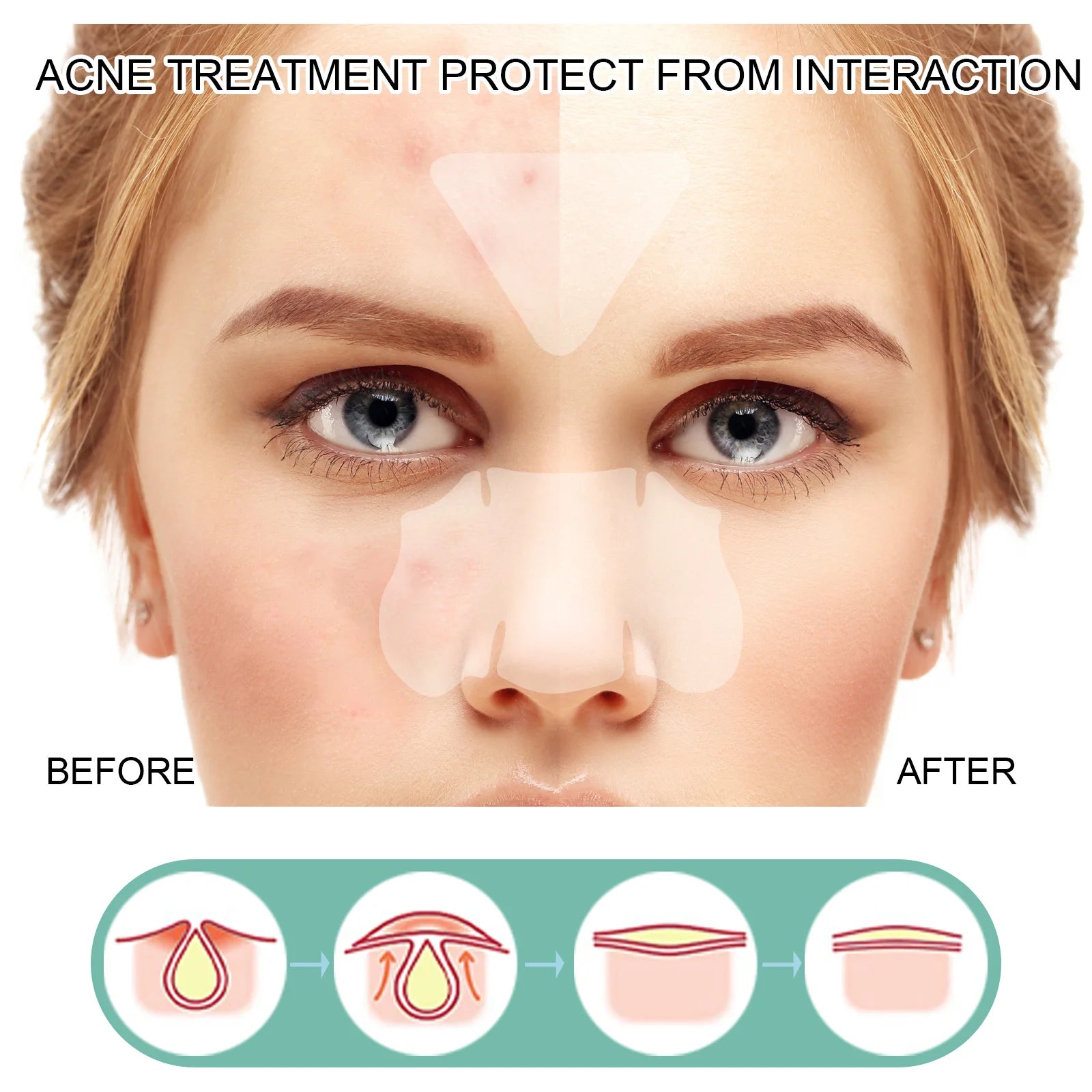132Pcs Acne Pimple Patch Breathable Invisible Hydrocolloid Sticker Blemish Treatment Patches Relief Redness Pimple Care Stickers