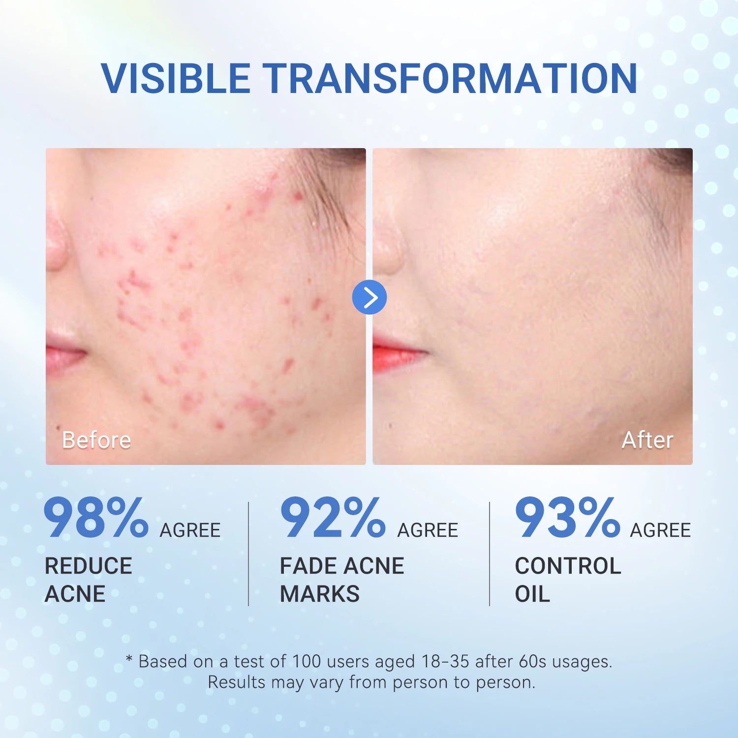 Dr.Leo Acne Serum Salicylic Acid Acne Essence Anti-acne Serum Pimple Removal Acne Scars And Pores Skin Care